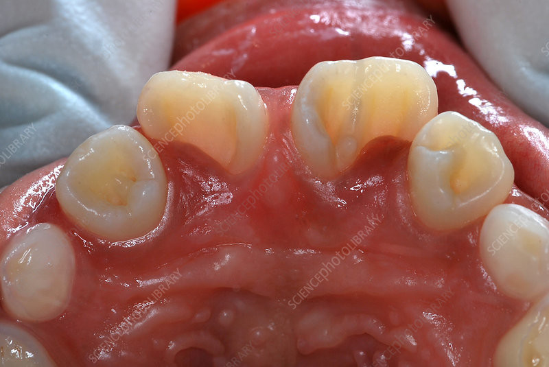Dens In Dente Is Most Commonly Associated With