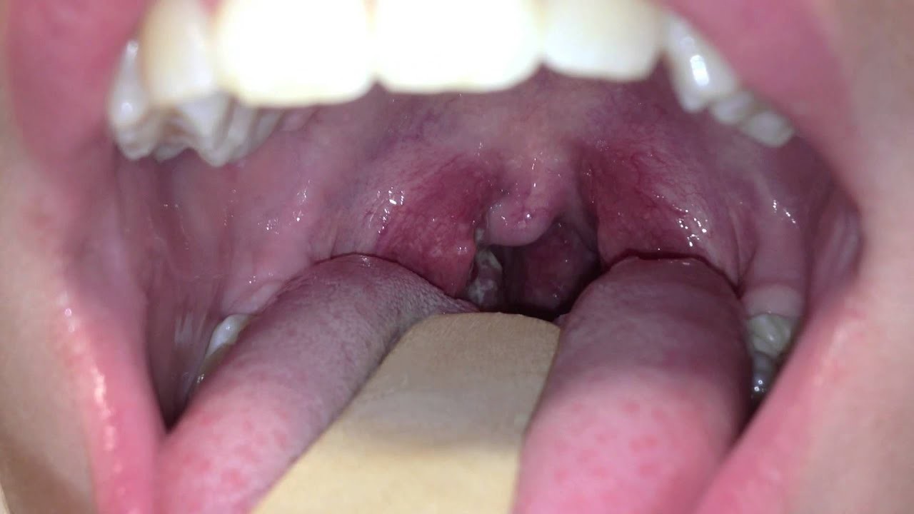 Sore throat, causes and symptoms My BEST Dentists Journal