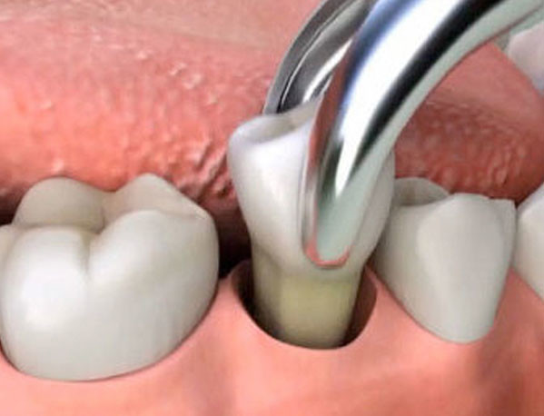 How to prevent dry socket after a tooth extraction - My BEST Dentists ...