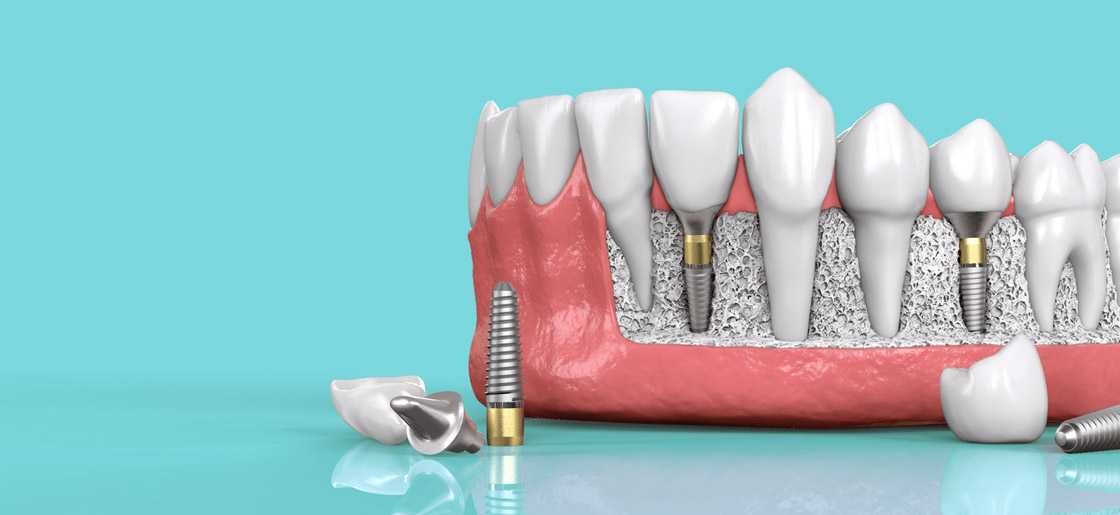 The vitamin D is crucial for a dental implant success My BEST