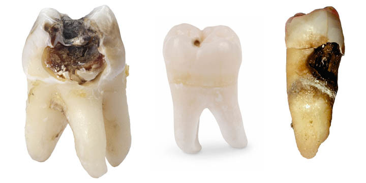 Tooth decay on root surfaces - My BEST Dentists Journal - MyBestDentists