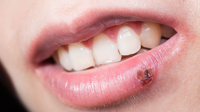 what-causes-a-scab-on-the-lip-my-best-dentists-journal-mybestdentists