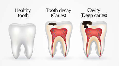 The 3 most common types of cavities that people are prone to - My BEST ...