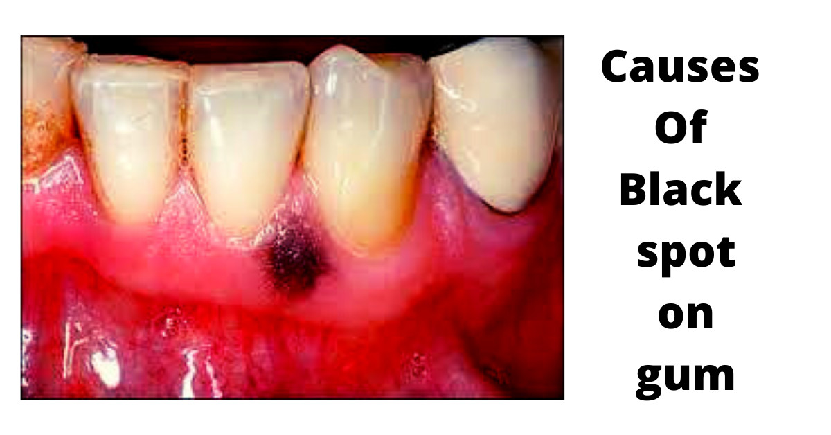 What Causes a Dark Spot on Gums? My BEST Dentists Journal