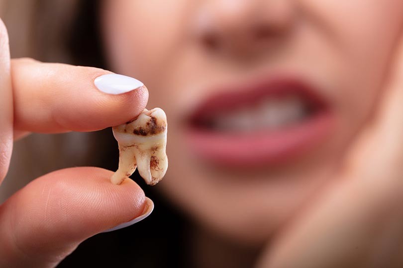 What Causes Rotten Teeth Symptoms And Treatment Options My BEST what-causes-rotten-teeth-symptoms-and-treatment-options-my-best