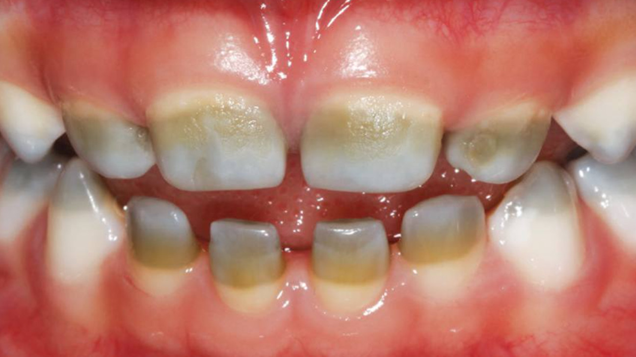 Translucent Teeth What Causes Them and How to Fix It My BEST