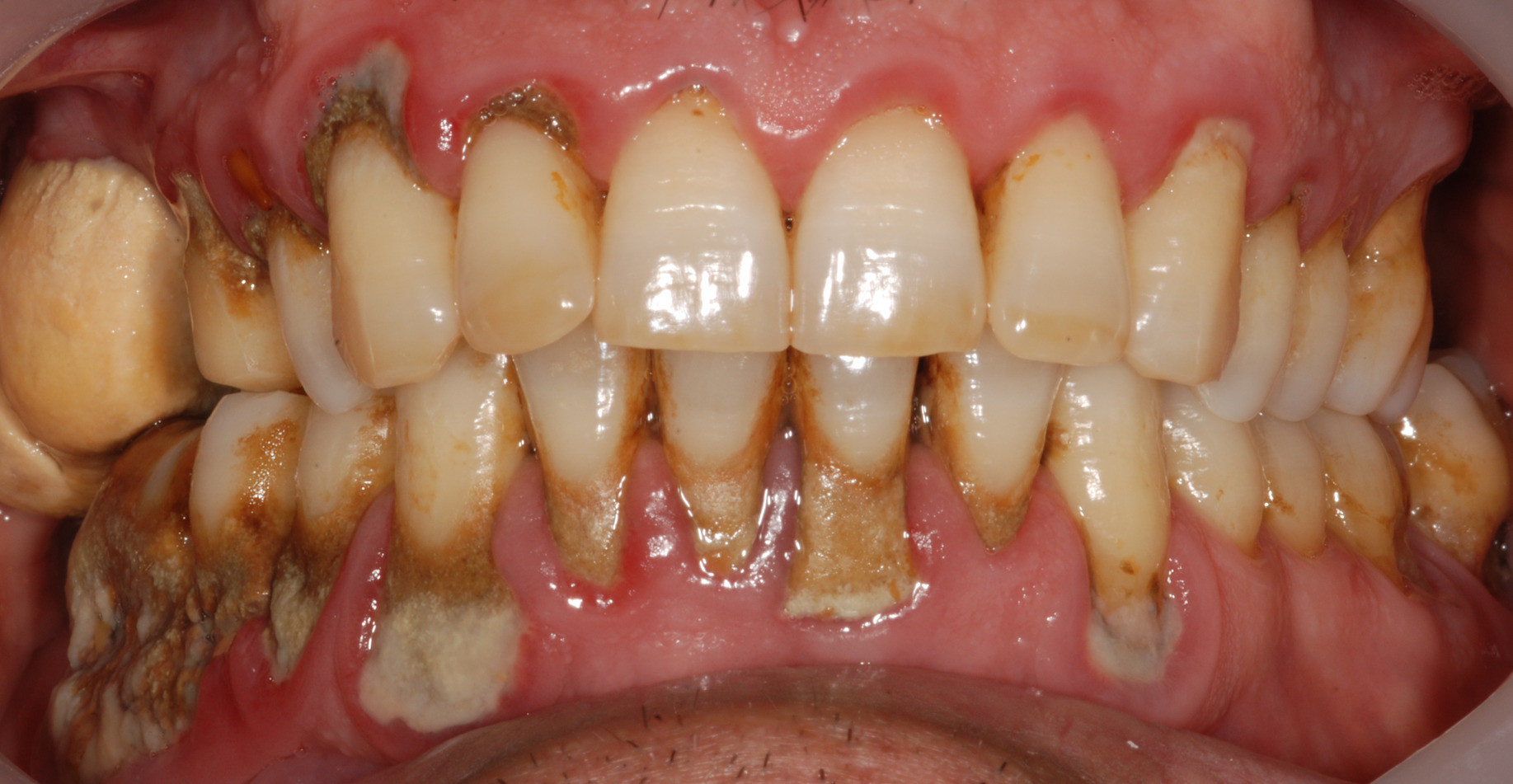 Tips to control tartar buildup - My BEST Dentists Journal - MyBestDentists