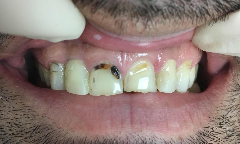 What Causes a Cavity on the Front Tooth My BEST Dentists Journal 