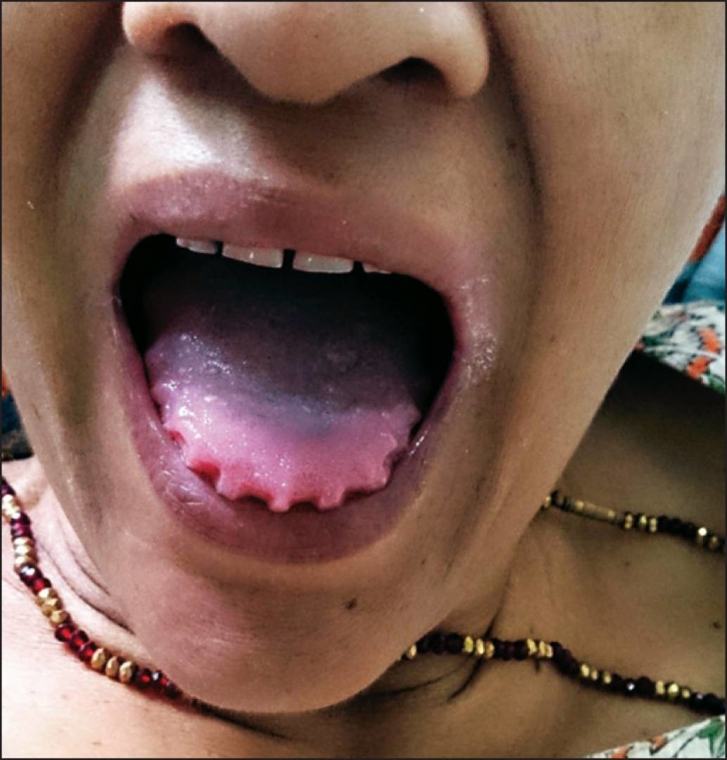 What Causes a Scalloped Tongue? My BEST Dentists Journal MyBestDentists