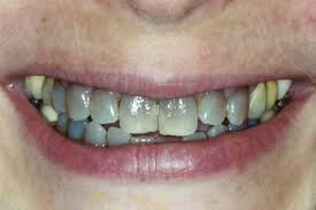 Black Teeth Symptoms Causes And Treatment My Best Dentists Journal