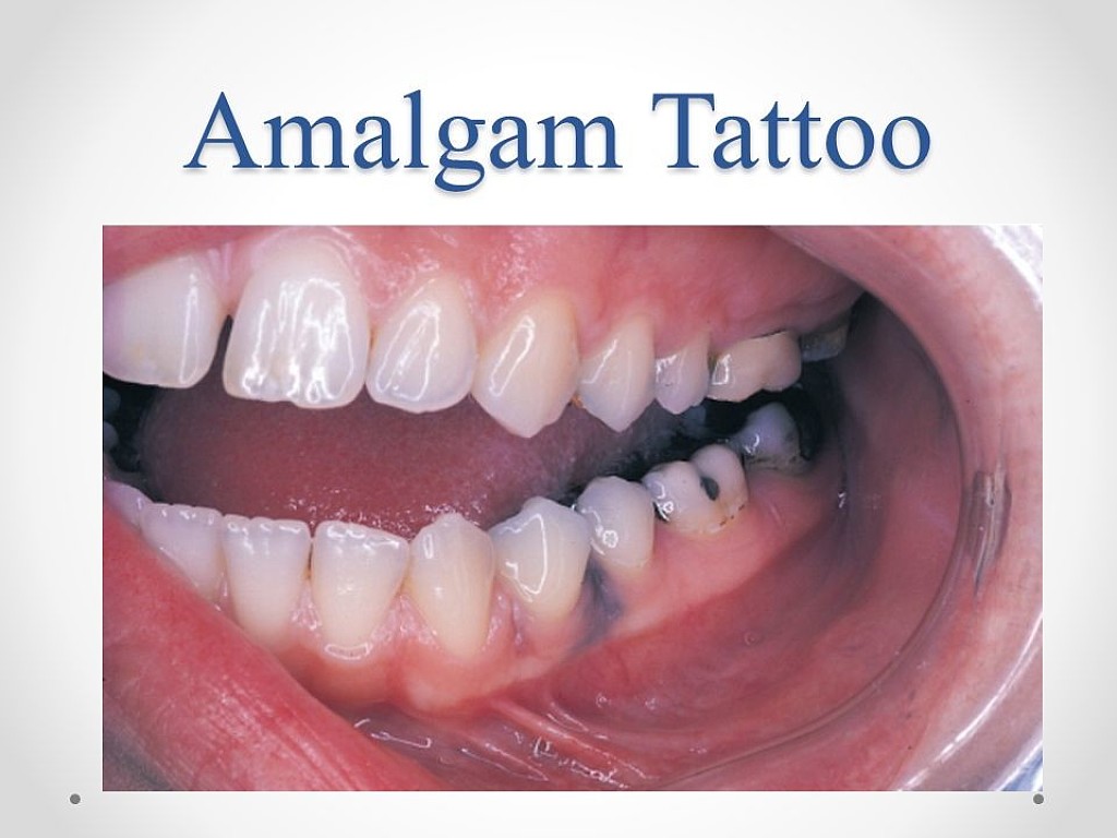 What are Amalgam Tattoos? My BEST Dentists Journal MyBestDentists