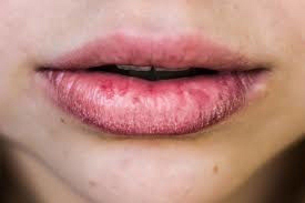 Can Vitamin Deficiency Cause Chronic Chapped Lips? My BEST Dentists