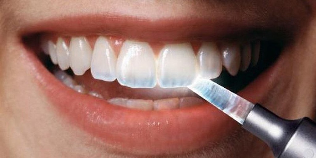 Translucent Teeth What Causes Them And How To Fix It My Best