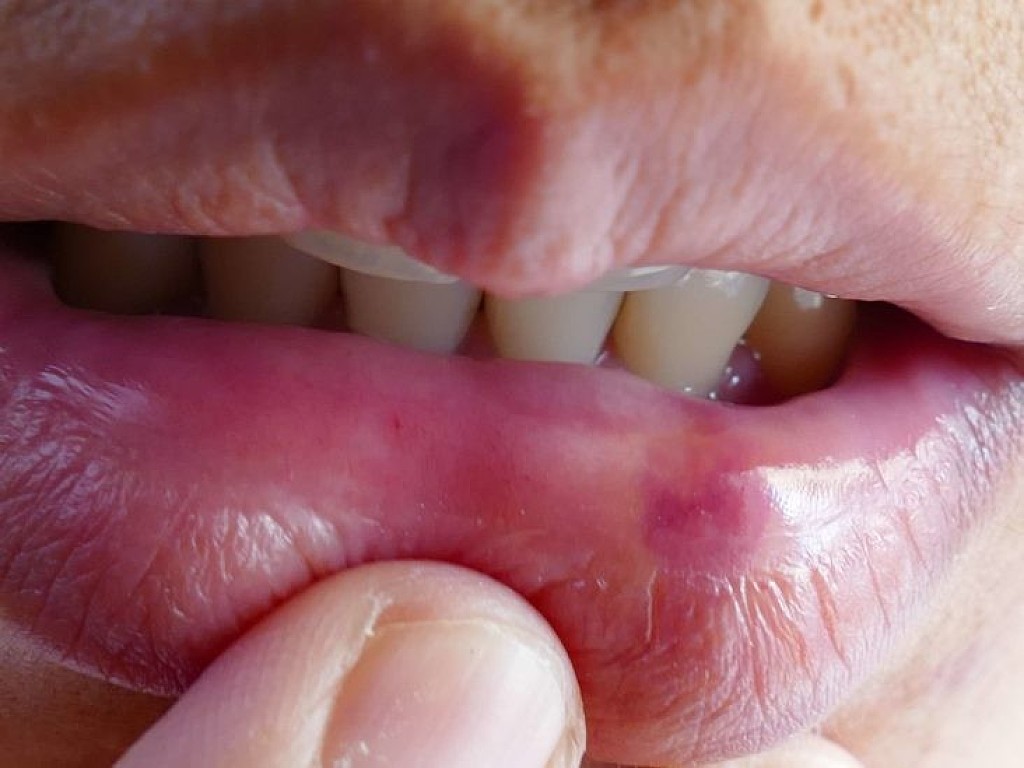 Swollen Lip Causes And Treatments My BEST Dentists Journal