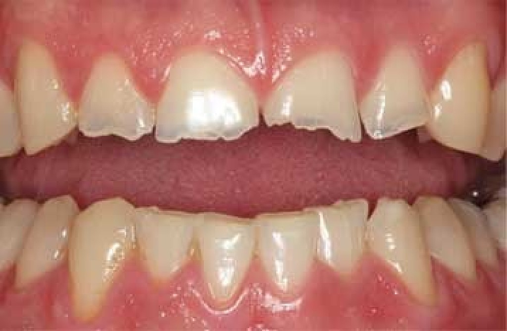 How to Manage Brittle Teeth My BEST Dentists Journal MyBestDentists
