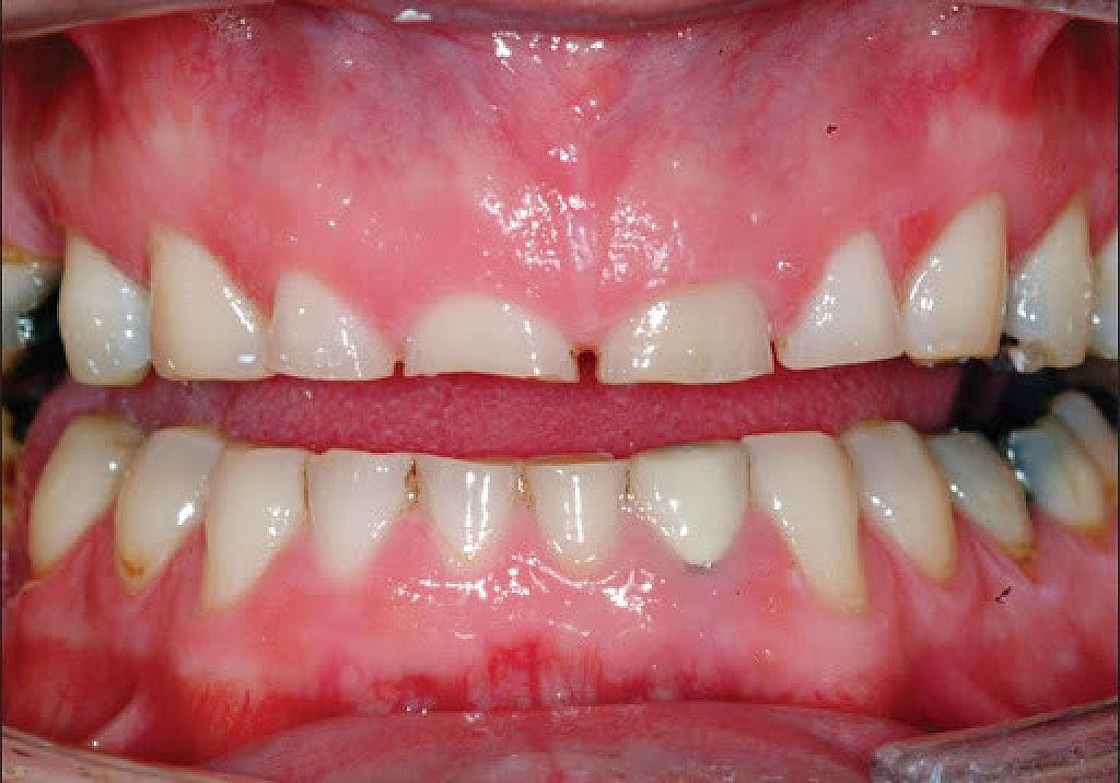 What is Dental Attrition? My BEST Dentists Journal MyBestDentists