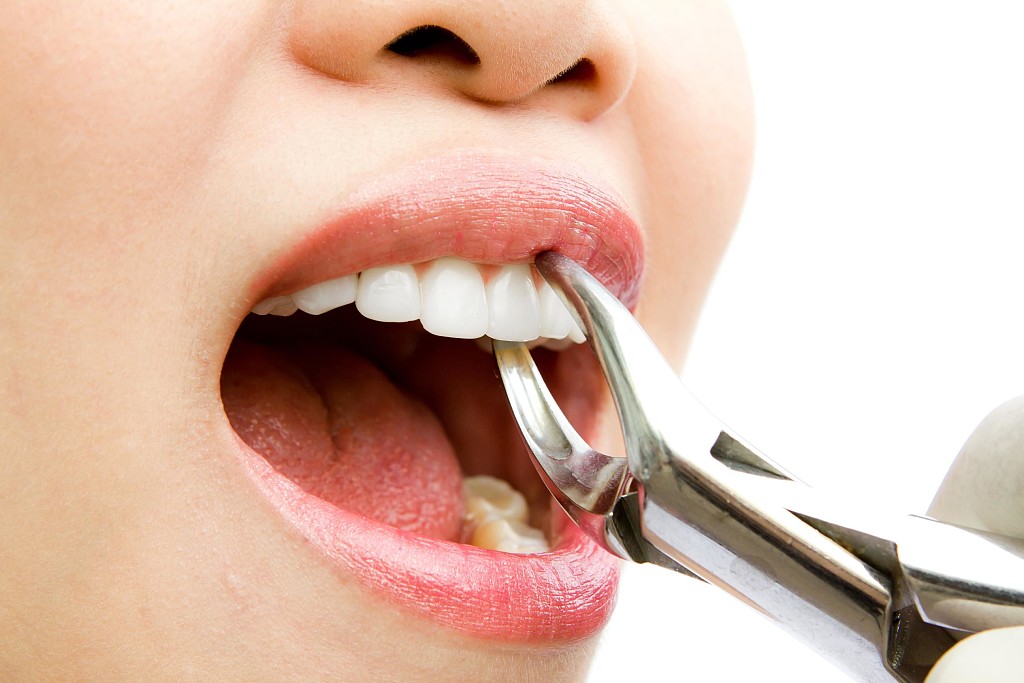 how-to-prevent-dry-socket-after-a-tooth-extraction-my-best-dentists